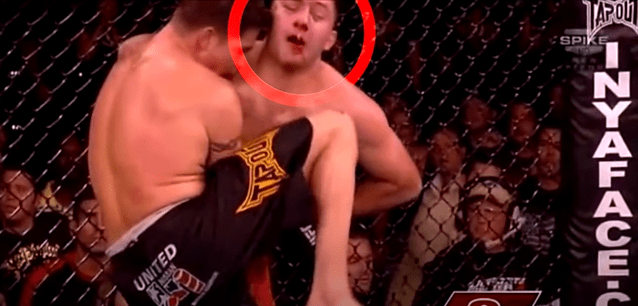 MMA-fighter-lose-their-teeth